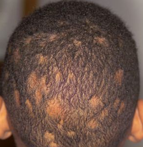 Ringworm On Scalp And How To Deal With It - Hairstyle Laboratory